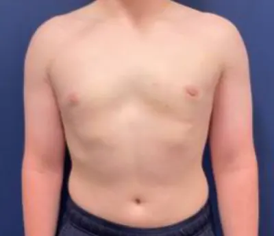 Gynecomastia / Male Breast Reduction Case #214 — after, Dr. Samir Rao