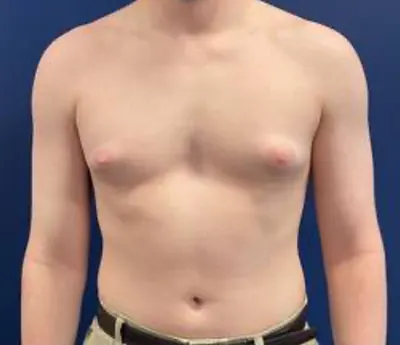 Gynecomastia / Male Breast Reduction Case #214 — before, Dr. Samir Rao