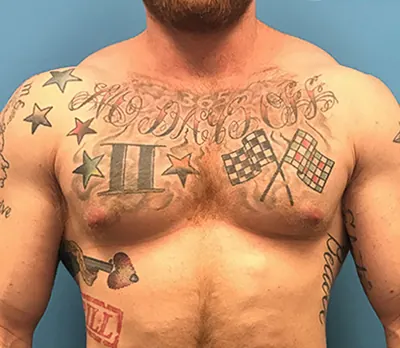 Gynecomastia / Male Breast Reduction Case #gynecomastia — after, Dr. Samir Rao