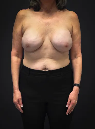 Breast Reconstruction Case #2969 — after, Dr. Samir Rao