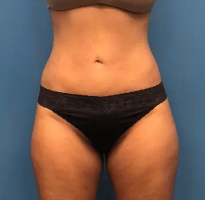 Liposuction Case #277 — after, Dr. Samir Rao