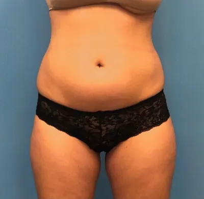 Liposuction Case #277 — before, Dr. Samir Rao