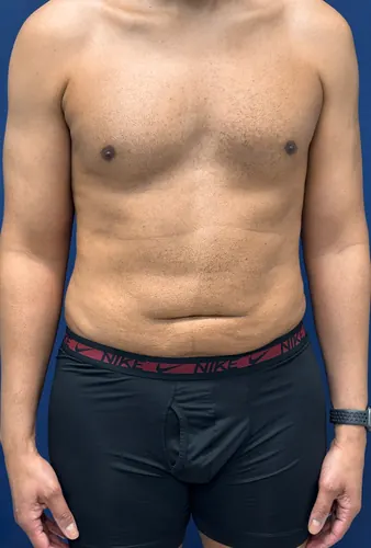 Liposuction Case #4979 — after, Dr. Arjun Kanuri