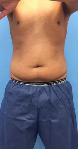 Liposuction Case #4979 — before, Dr. Arjun Kanuri