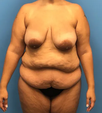 Mommy Makeover Case #15133 — before, Dr. Samir Rao