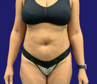 Tummy Tuck Case #21755 — before, Dr. Frank Albino