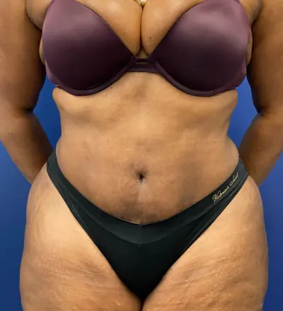 Tummy Tuck Case #24124 — after, Dr. Arjun Kanuri