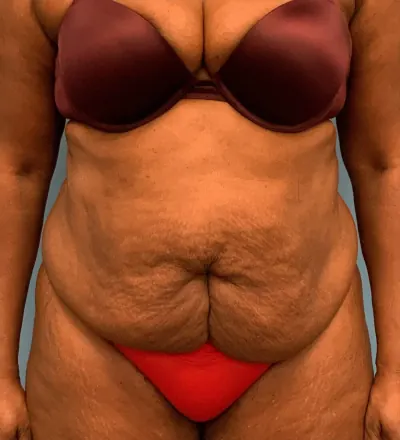 Tummy Tuck Case #24124 — before, Dr. Arjun Kanuri