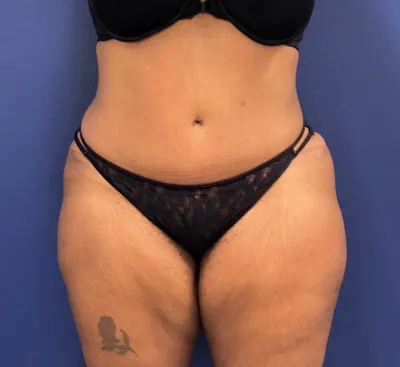 Tummy Tuck Case #245 — after, Dr. Samir Rao