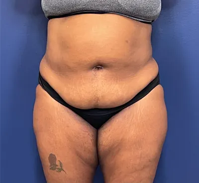 Tummy Tuck Case #245 — before, Dr. Samir Rao