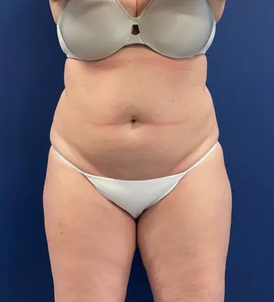 Tummy Tuck Case #24903 — before, Dr. Samir Rao