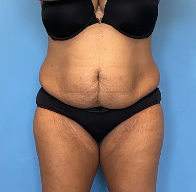 Tummy Tuck Case #255 — before, Dr. Samir Rao
