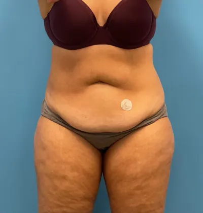 Tummy Tuck Case #25555 — before, Dr. Samir Rao