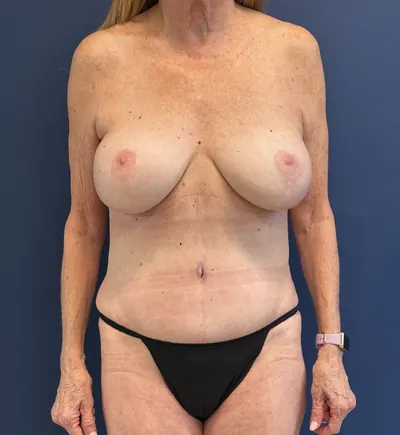 Tummy Tuck Case #27935 — after, Dr. Samir Rao