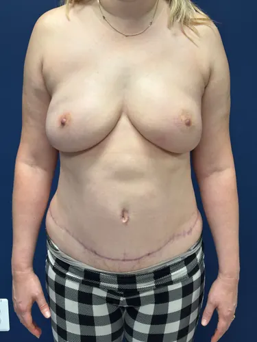 Tummy Tuck Case #3335 — after, Dr. Frank Albino