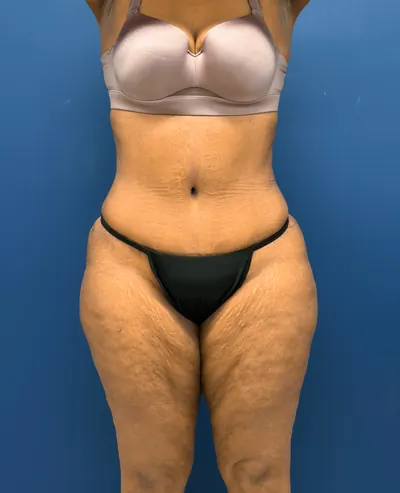 Tummy Tuck Case #6846 — after, Dr. Samir Rao