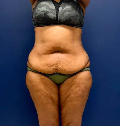 Tummy Tuck Case #6846 — before, Dr. Samir Rao