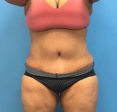 Tummy Tuck Case #lipoabdominoplasty — after, Dr. Samir Rao