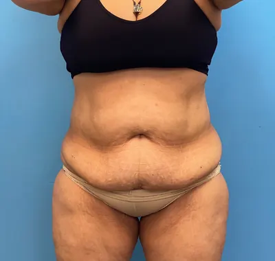 Tummy Tuck Case #lipoabdominoplasty — before, Dr. Samir Rao