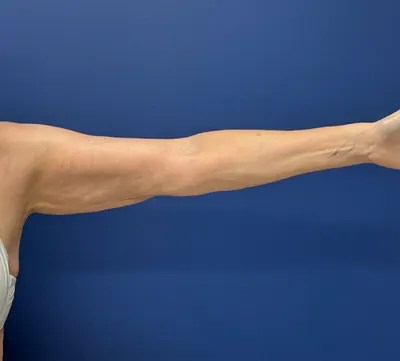 Liposuction Case #2 — after, Dr. Samir Rao