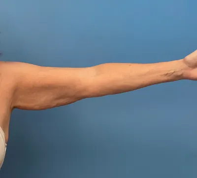 Liposuction Case #2 — before, Dr. Samir Rao