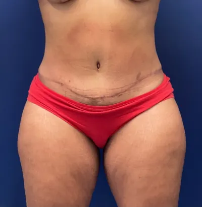 Liposuction Case #254 — after, Dr. Samir Rao