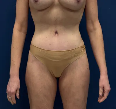 Liposuction Case #3054 — after, Dr. Frank Albino
