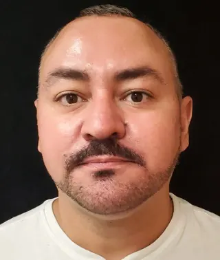 Submental Liposuction Case #368 — after, Dr. Arjun Kanuri