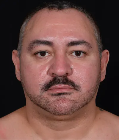 Submental Liposuction Case #368 — before, Dr. Arjun Kanuri