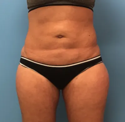 Liposuction Case #1 — after, Dr. Samir Rao