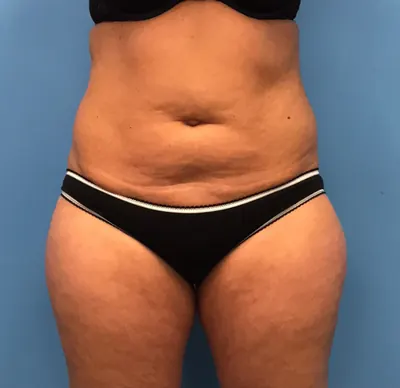 Liposuction Case #1 — before, Dr. Samir Rao