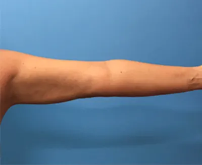 Liposuction Case #2 — after, Dr. Samir Rao