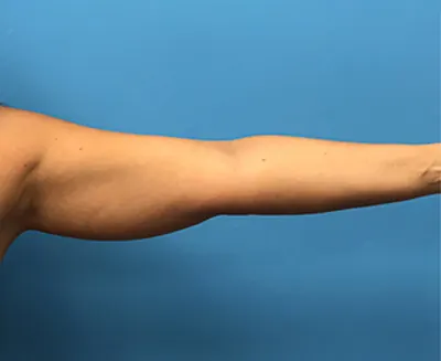 Liposuction Case #2 — before, Dr. Samir Rao