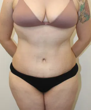 Tummy Tuck Case #343 — after, Dr. Arjun Kanuri