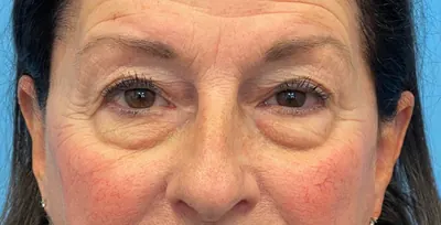 Eyelid Surgery Case #26440 — before, Dr. Samir Rao
