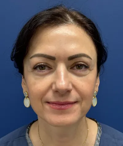 Eyelid Surgery Case #26939 — after, Dr. Samir Rao