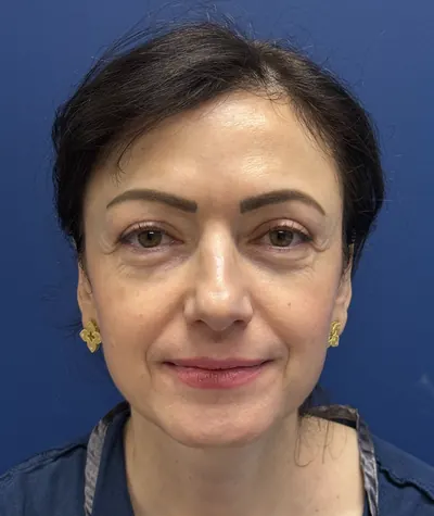 Eyelid Surgery Case #26939 — before, Dr. Samir Rao