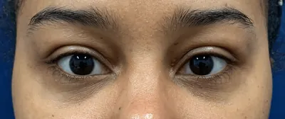 Eyelid Surgery Case #28049 — after, Dr. Samir Rao