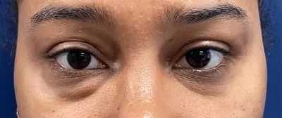 Eyelid Surgery Case #28049 — before, Dr. Samir Rao