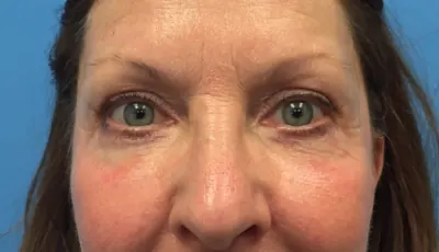 Eyelid Surgery Case #287 — after, Dr. Samir Rao