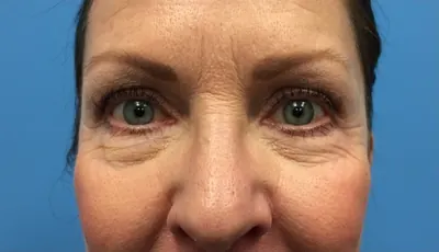 Eyelid Surgery Case #287 — before, Dr. Samir Rao