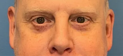 Eyelid Surgery Case #289 — after, Dr. Samir Rao