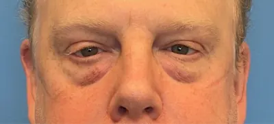 Eyelid Surgery Case #289 — before, Dr. Samir Rao