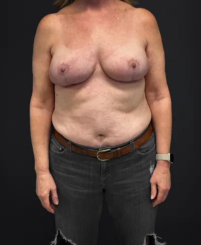 Breast Reconstruction Case #9351 — after, Dr. Samir Rao