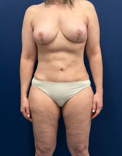 Mommy Makeover Case #9485 — after, Dr. Samir Rao
