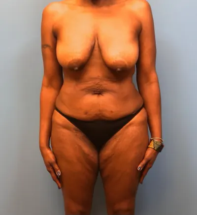 Mommy Makeover Case #13869 — before, Dr. Samir Rao