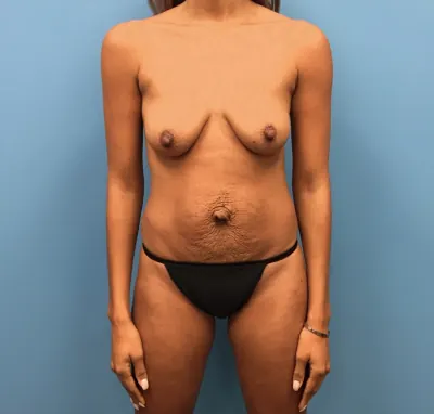 Mommy Makeover Case #262 — before, Dr. Samir Rao