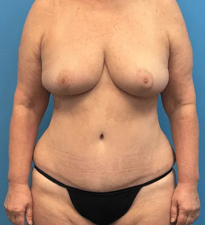 Mommy Makeover Case #27387 — after, Dr. Samir Rao
