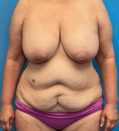 Mommy Makeover Case #27387 — before, Dr. Samir Rao