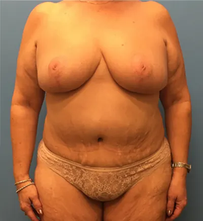 Mommy Makeover Case #39 — after, Dr. Samir Rao